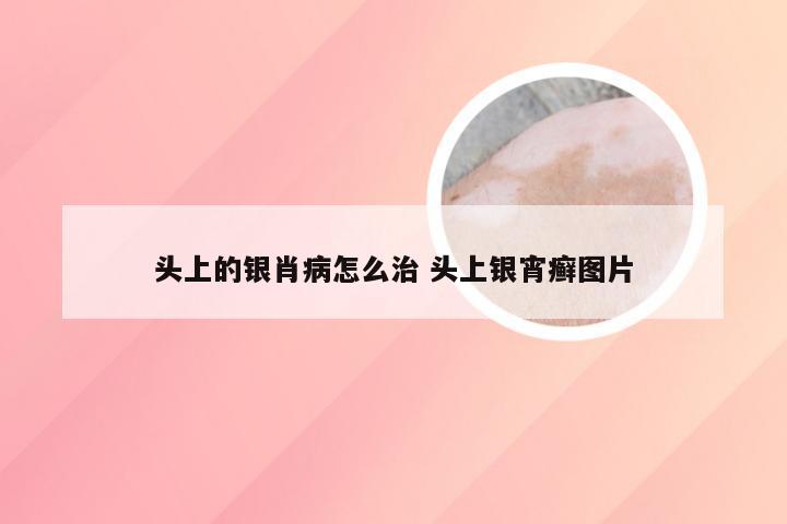 头上的银肖病怎么治 头上银宵癣图片