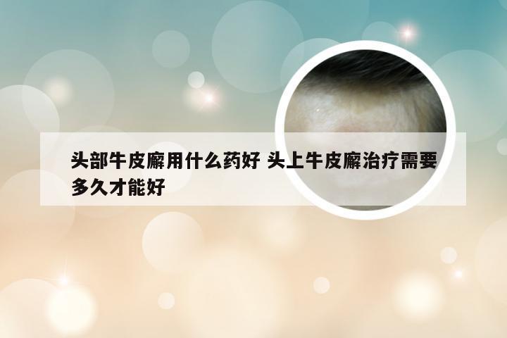 头部牛皮廨用什么药好 头上牛皮廨治疗需要多久才能好