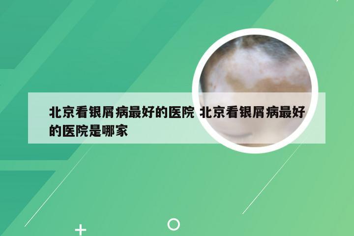 北京看银屑病最好的医院 北京看银屑病最好的医院是哪家