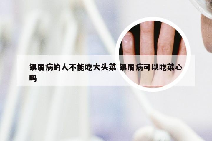 银屑病的人不能吃大头菜 银屑病可以吃菜心吗