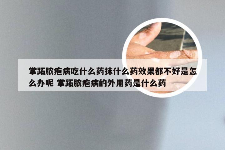 掌跖脓疱病吃什么药抹什么药效果都不好是怎么办呢 掌跖脓疱病的外用药是什么药