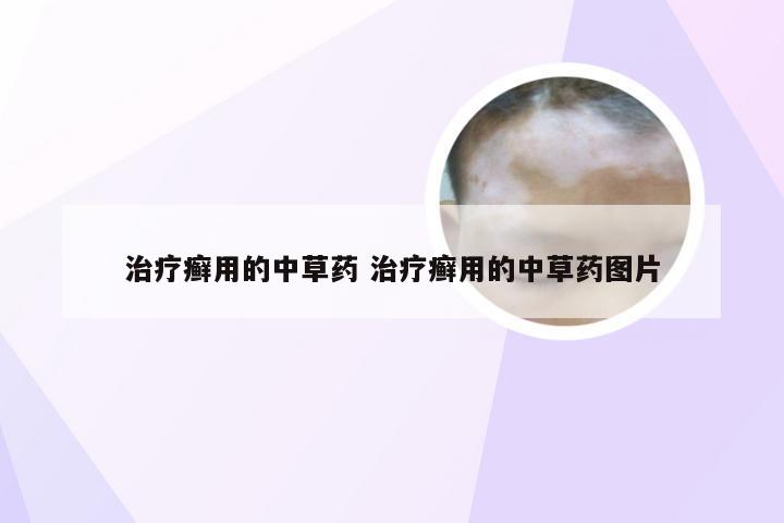 治疗癣用的中草药 治疗癣用的中草药图片