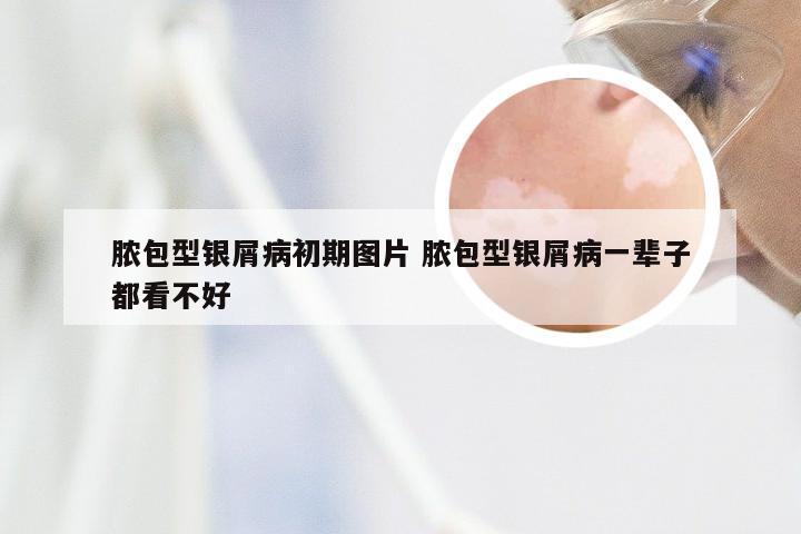 脓包型银屑病初期图片 脓包型银屑病一辈子都看不好