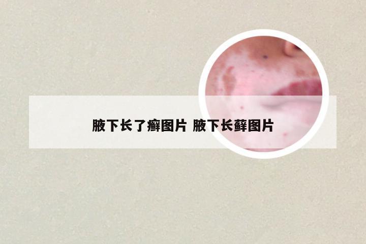腋下长了癣图片 腋下长藓图片