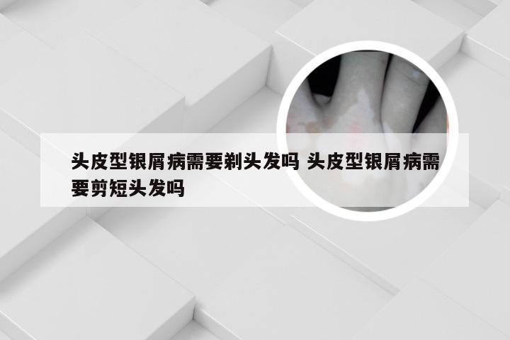 头皮型银屑病需要剃头发吗 头皮型银屑病需要剪短头发吗