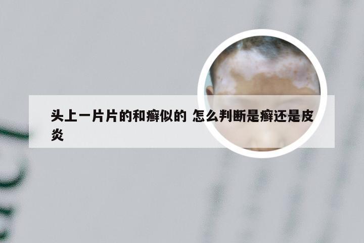 头上一片片的和癣似的 怎么判断是癣还是皮炎