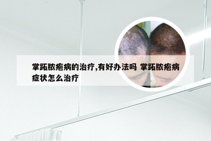 掌跖脓疱病的治疗,有好办法吗 掌跖脓疱病症状怎么治疗