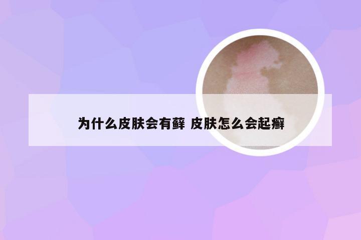 为什么皮肤会有藓 皮肤怎么会起癣