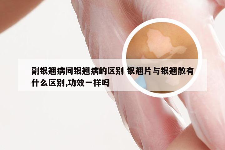 副银翘病同银翘病的区别 银翘片与银翘散有什么区别,功效一样吗
