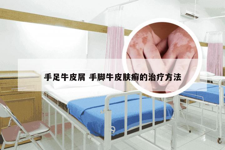 手足牛皮屑 手脚牛皮肤癣的治疗方法