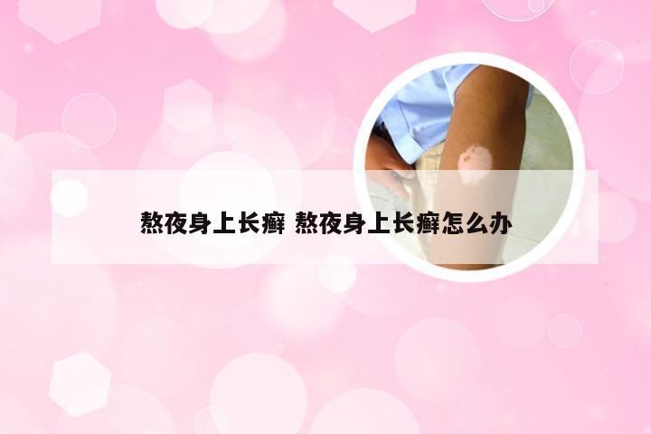 熬夜身上长癣 熬夜身上长癣怎么办