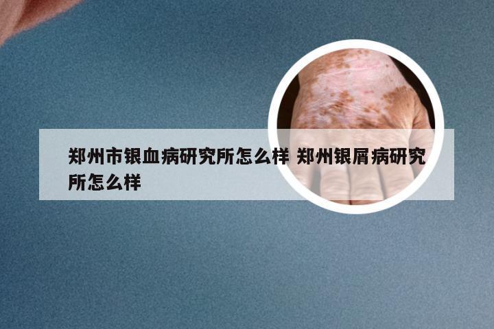 郑州市银血病研究所怎么样 郑州银屑病研究所怎么样
