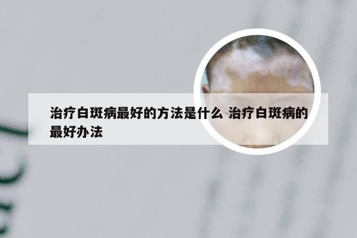 治疗白斑病最好的方法是什么 治疗白斑病的最好办法