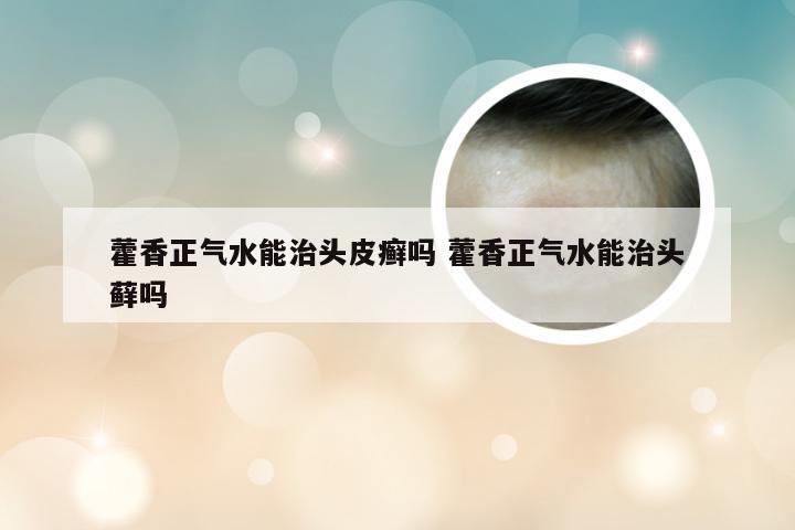 藿香正气水能治头皮癣吗 藿香正气水能治头藓吗