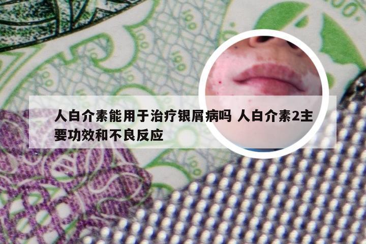 人白介素能用于治疗银屑病吗 人白介素2主要功效和不良反应
