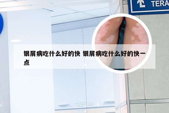银屑病吃什么好的快 银屑病吃什么好的快一点