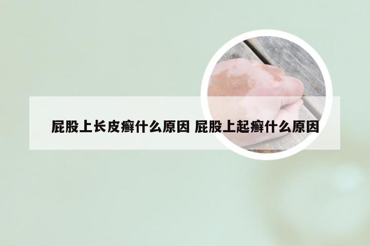 屁股上长皮癣什么原因 屁股上起癣什么原因