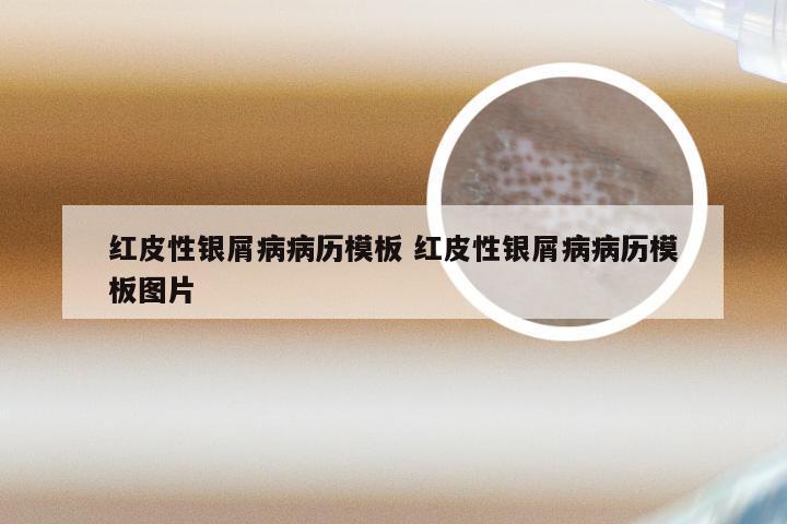 红皮性银屑病病历模板 红皮性银屑病病历模板图片