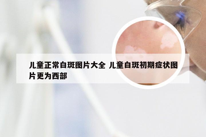 儿童正常白斑图片大全 儿童白斑初期症状图片更为西部