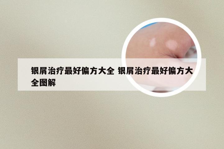 银屑治疗最好偏方大全 银屑治疗最好偏方大全图解