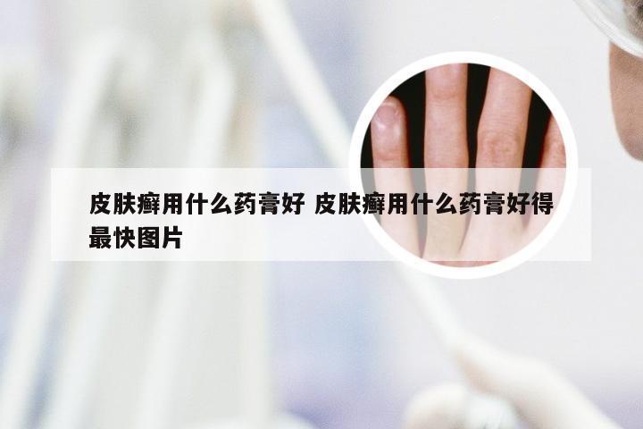 皮肤癣用什么药膏好 皮肤癣用什么药膏好得最快图片