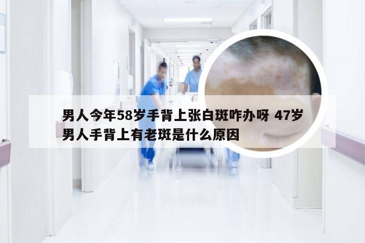 男人今年58岁手背上张白斑咋办呀 47岁男人手背上有老斑是什么原因