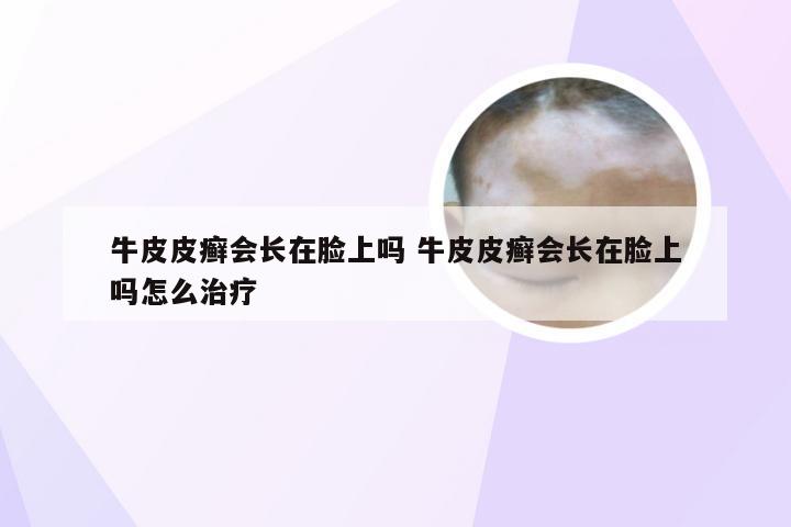 牛皮皮癣会长在脸上吗 牛皮皮癣会长在脸上吗怎么治疗