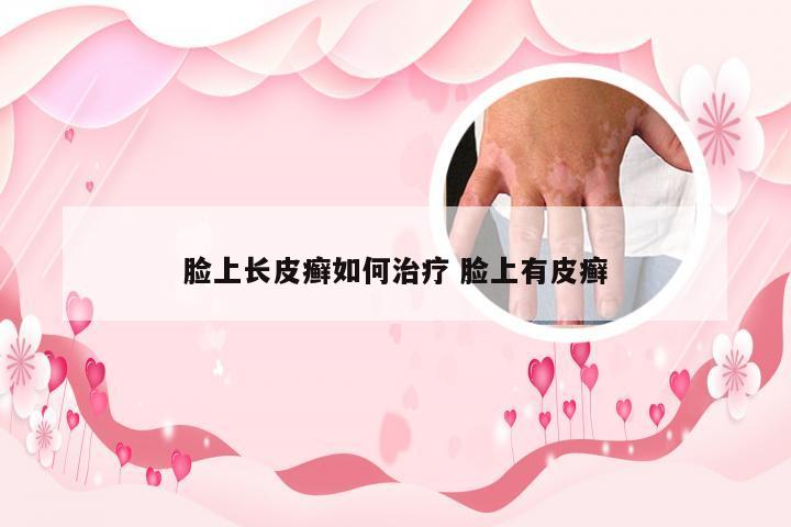 脸上长皮癣如何治疗 脸上有皮癣