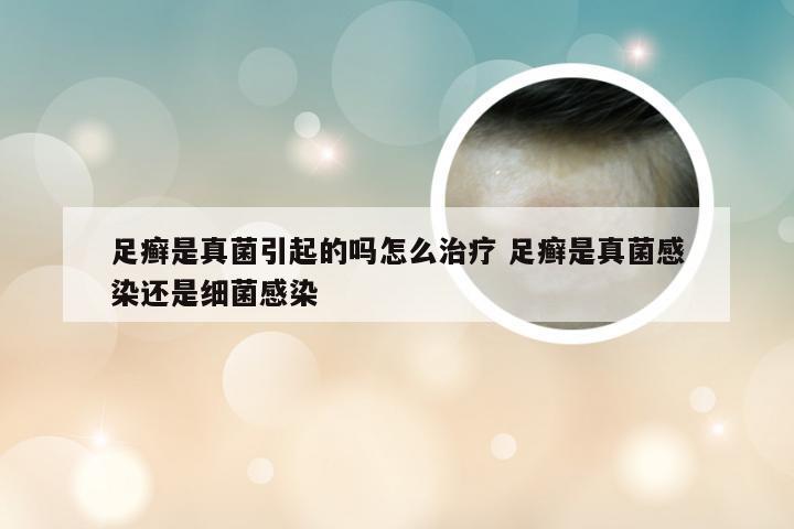 足癣是真菌引起的吗怎么治疗 足癣是真菌感染还是细菌感染