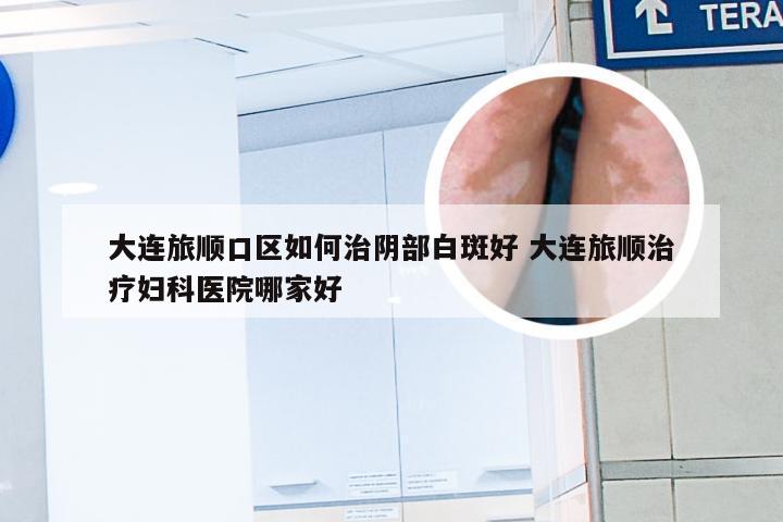 大连旅顺口区如何治阴部白斑好 大连旅顺治疗妇科医院哪家好