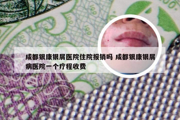 成都银康银屑医院住院报销吗 成都银康银屑病医院一个疗程收费