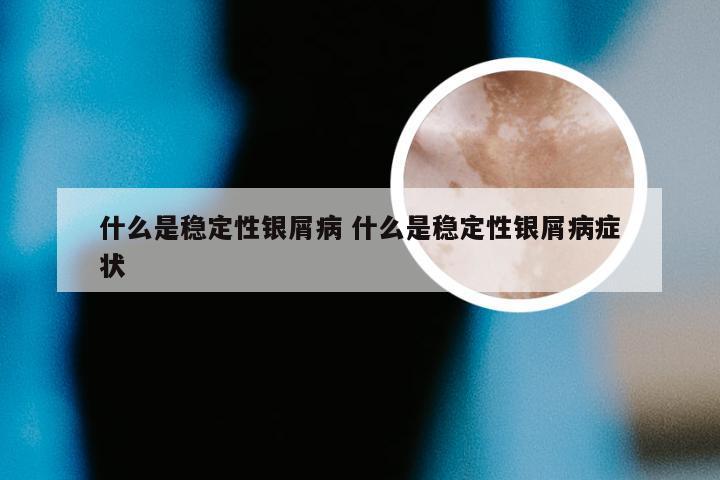 什么是稳定性银屑病 什么是稳定性银屑病症状