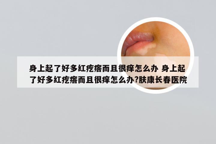 身上起了好多红疙瘩而且很痒怎么办 身上起了好多红疙瘩而且很痒怎么办?肤康长春医院