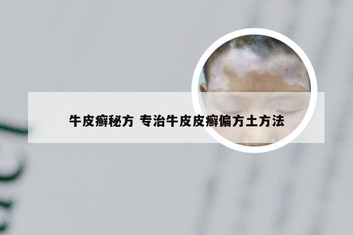 牛皮癣秘方 专治牛皮皮癣偏方土方法