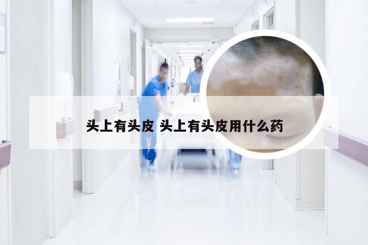 头上有头皮 头上有头皮用什么药