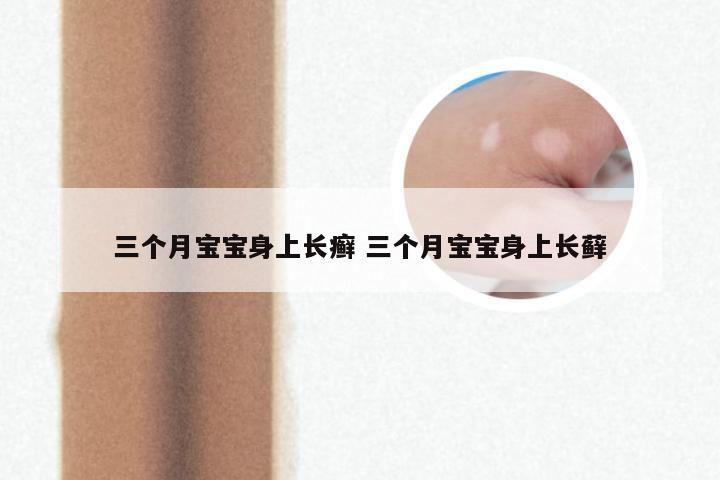 三个月宝宝身上长癣 三个月宝宝身上长藓