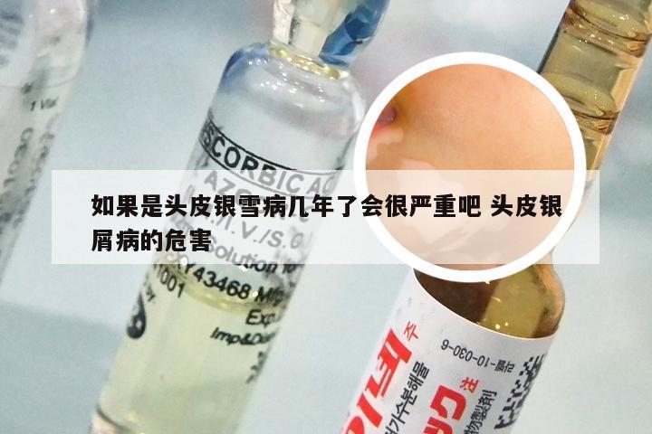 如果是头皮银雪病几年了会很严重吧 头皮银屑病的危害