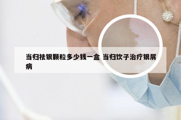 当归祛银颗粒多少钱一盒 当归饮子治疗银屑病