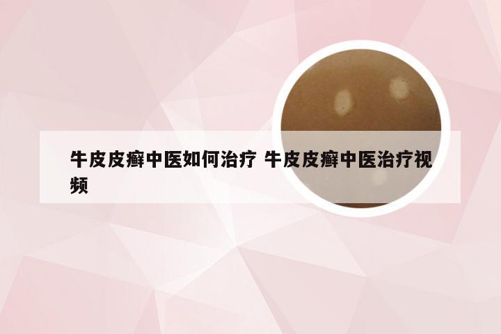 牛皮皮癣中医如何治疗 牛皮皮癣中医治疗视频