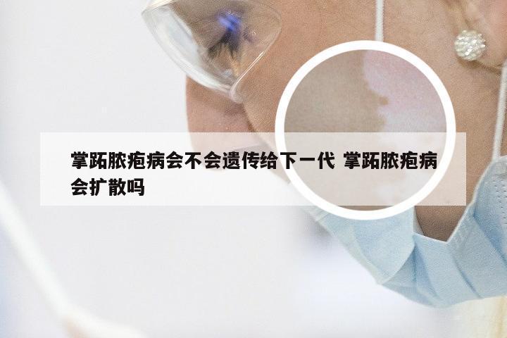 掌跖脓疱病会不会遗传给下一代 掌跖脓疱病会扩散吗