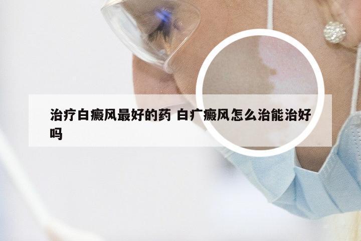 治疗白癜风最好的药 白疒癜风怎么治能治好吗