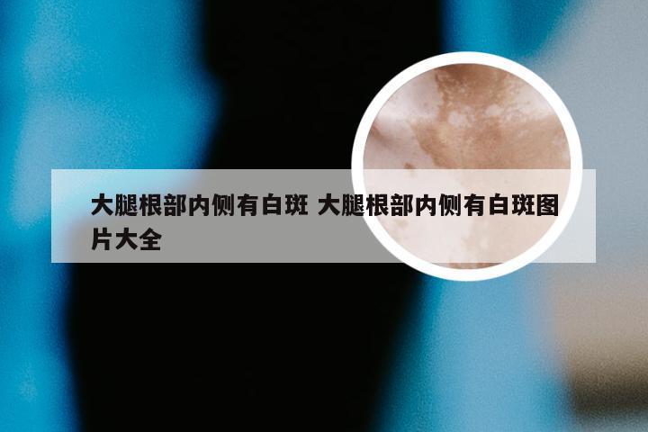 大腿根部内侧有白斑 大腿根部内侧有白斑图片大全