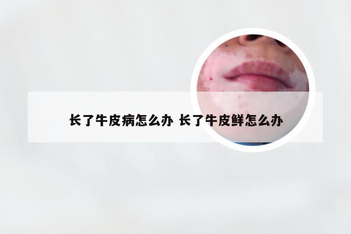 长了牛皮病怎么办 长了牛皮鲜怎么办