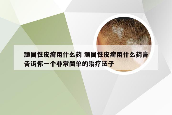 顽固性皮癣用什么药 顽固性皮癣用什么药膏告诉你一个非常简单的治疗法子