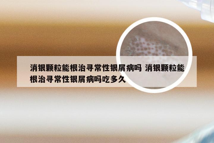 消银颗粒能根治寻常性银屑病吗 消银颗粒能根治寻常性银屑病吗吃多久