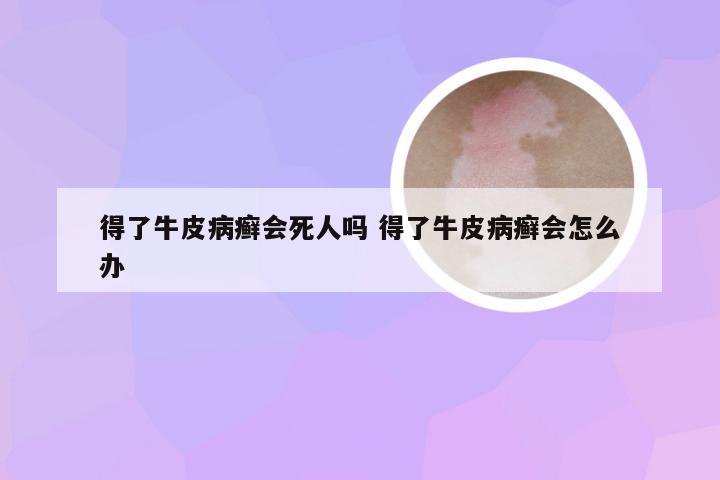 得了牛皮病癣会死人吗 得了牛皮病癣会怎么办