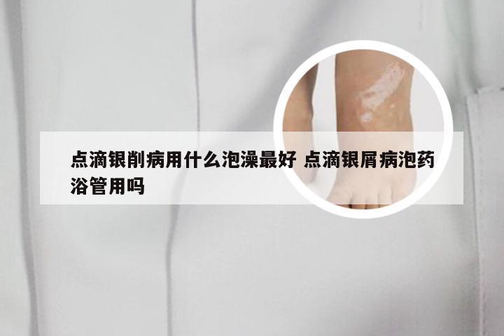 点滴银削病用什么泡澡最好 点滴银屑病泡药浴管用吗
