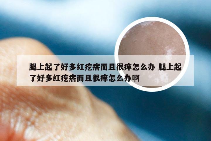 腿上起了好多红疙瘩而且很痒怎么办 腿上起了好多红疙瘩而且很痒怎么办啊