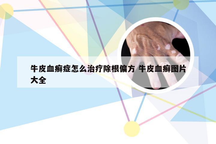 牛皮血癣症怎么治疗除根偏方 牛皮血癣图片大全