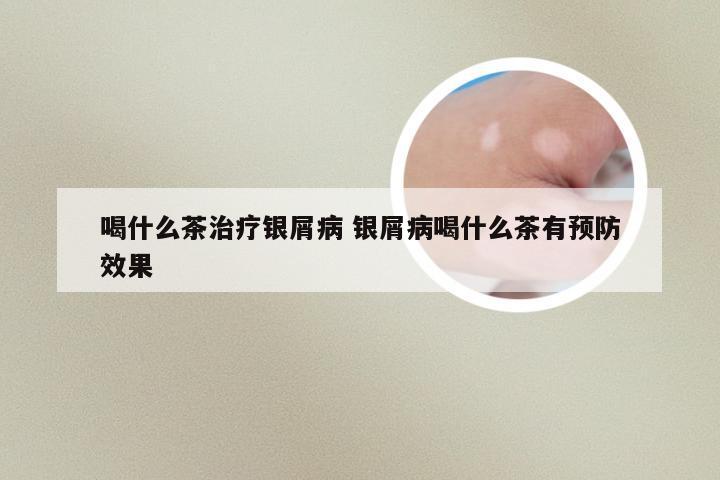 喝什么茶治疗银屑病 银屑病喝什么茶有预防效果